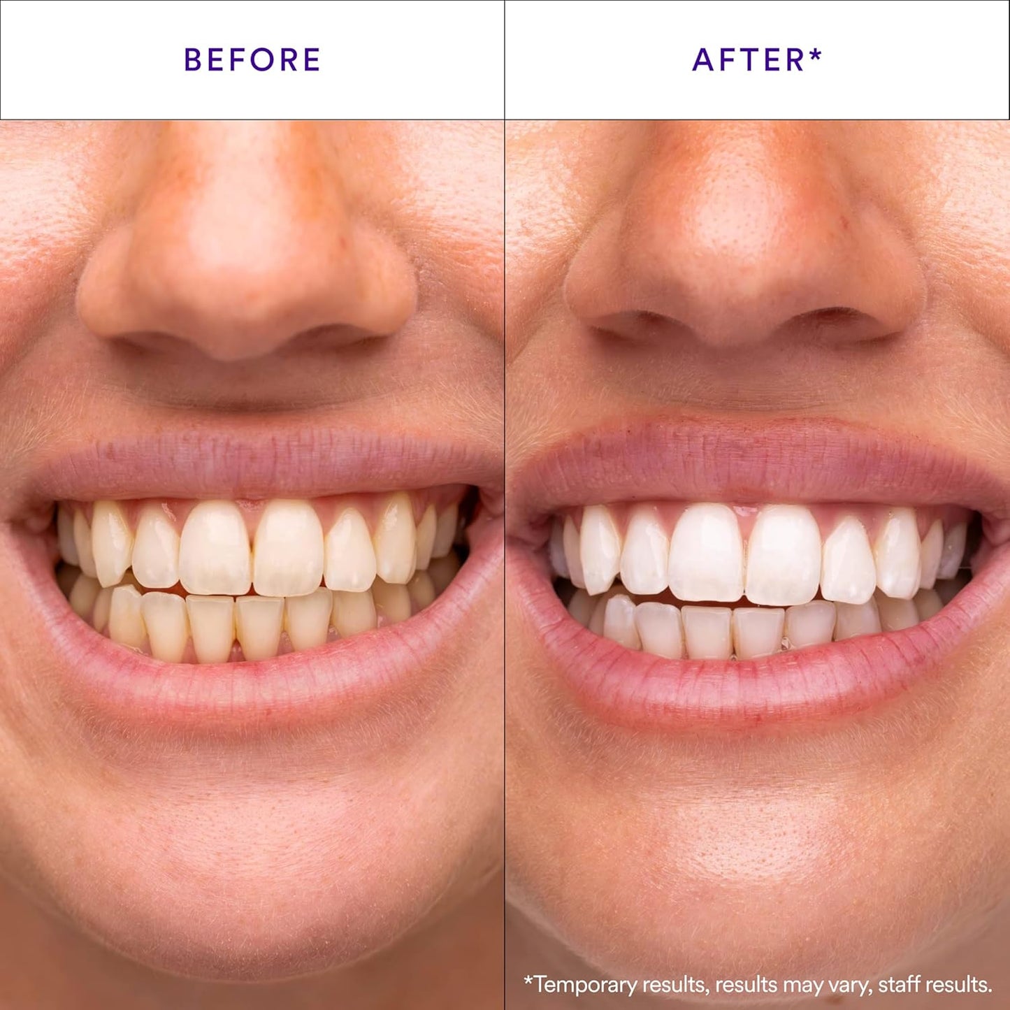 Hismile V34 Whitening Strips, Tooth Stain Treatment, Combining Whitening and Colour Correction