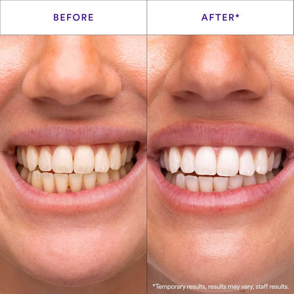 Hismile V34 Whitening Strips, Tooth Stain Treatment, Combining Whitening and Colour Correction